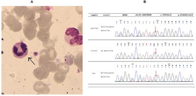 Case Report: Pathogenic MYH9 c.5797delC Mutation in a Patient With Apparent Thrombocytopenia and Nephropathy